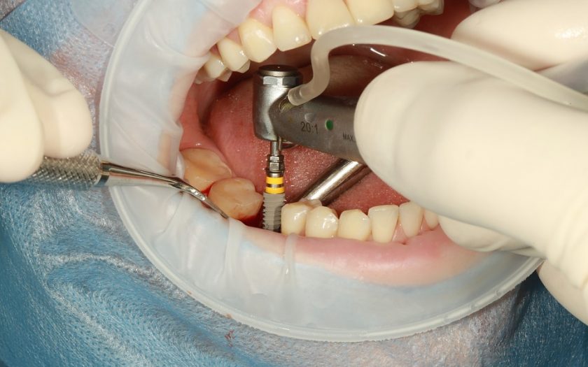 dental implant
