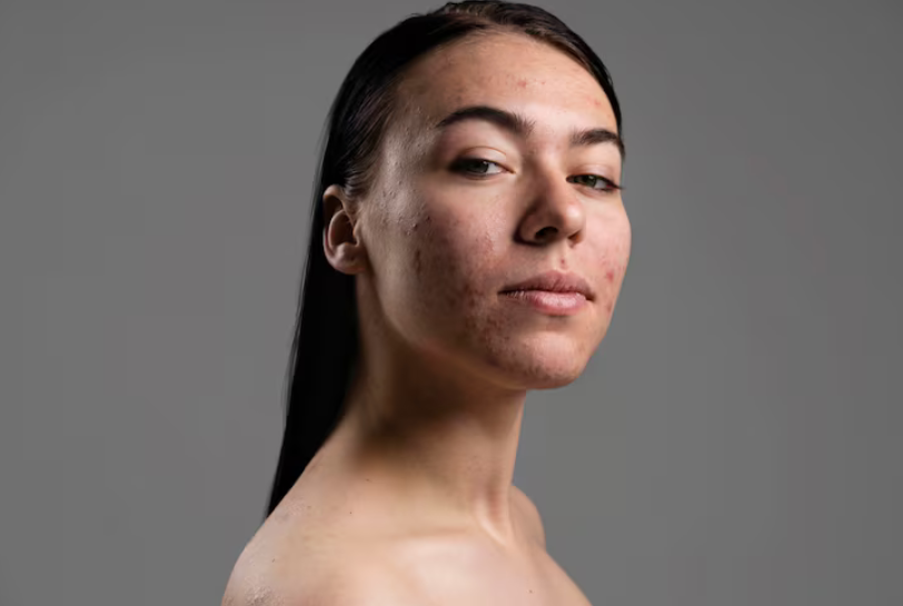 Beauty Tips If You Have Acne-Prone Skin
